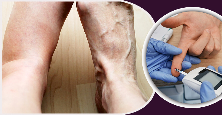 পায়ে যে ৪ লক্ষণ দেখলে দ্রুত ডায়াবেটিস টেস্ট করবেন